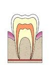 bilder hål i tand 1